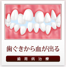 歯ぐきから血が出る 歯周病治療